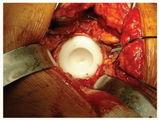 Illustration 25 for Cemented Acetabular Component: Achieving Optimal THA Stability