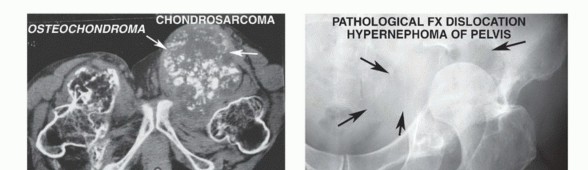 Illustration 4 for Posterior Flap Hemipelvectomy: Mastering Techniques for Optimal Outcomes