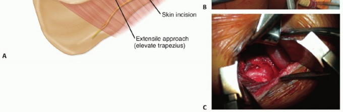 Illustration 16 for Decompressing the Transverse Scapular Ligament for Shoulder Pain Relief