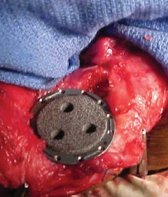 Illustration 18 for Solving Severe Bone Loss: Tantalum for Patellar Reconstruction