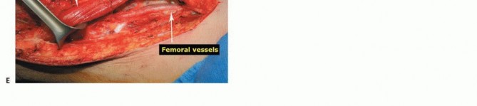 Illustration 29 for Advanced Distal Femoral Resections: Limb-Sparing Outcomes & Techniques