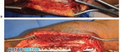 Illustration 25 for Optimal ORIF for Diaphyseal Forearm Fractures: Your Guide