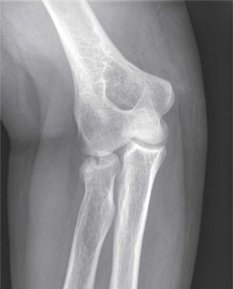 Radial Head Fracture: Symptoms, Diagnosis, and Surgical Indications