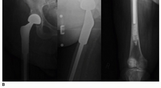 Illustration 2 for Allograft Prosthetic Composite: Mastering Proximal Femur Reconstruction
