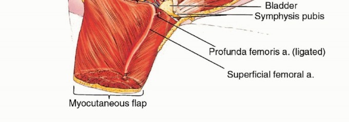 Illustration 32 for Anterior Flap Hemipelvectomy: Leveraging fig tech fig for Difficult Tumors