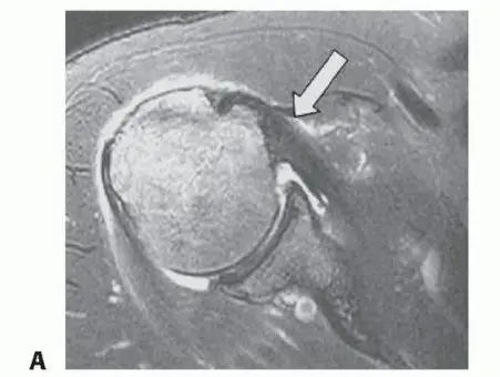 تمزق العضلة تحت الكتف ووتر العضلة ذات الرأسين: دليل شامل للعلاج والتعافي مع الأستاذ الدكتور محمد هطيف