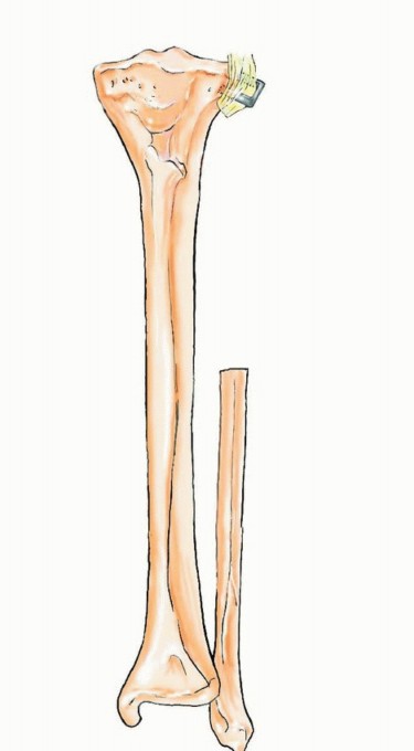 Illustration 38 for Free Vascularized Fibular Grafts: Solving Complex Bone Defects