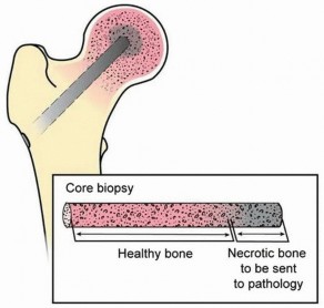 Illustration 2 for Head-Sparing for Osteonecrosis of the Femoral: Preserve Your Hip