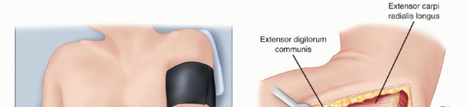 Illustration 5 for Radial Head Arthroplasty: Restoring Elbow Function & Stability