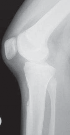 Illustration 3 for Cruciate Ligament Repair: Definitive Guide to Treatment & Recovery