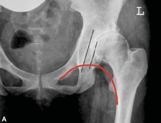 Illustration 31 for Optimizing Acetabular Component Cementation for Superior Outcomes