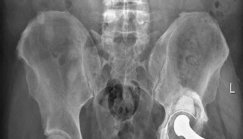 Revision THA: Unlocking Stability with Porous Tantalum Cups