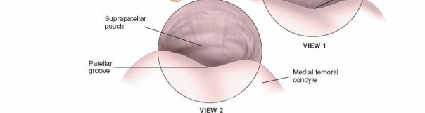 Illustration 10 for Mastering Knee Arthroscopy Approaches: Safely Withdraw the Arthroscope