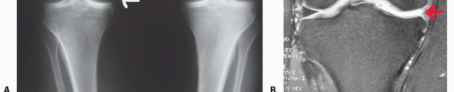 Illustration 4 for Symptomatic Knee? Meniscal Transplant for Anterior & Posterior Horns