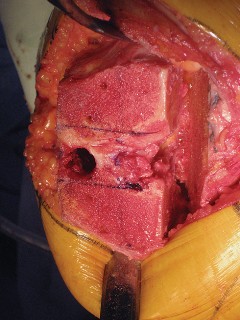 Illustration 37 for Posterior Stabilized Technique: Essential Insights for TKA Success