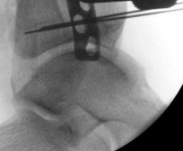 Illustration 26 for Tibial Fracture Extending into the Plafond: Intramedullary Secrets