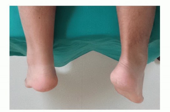 Regaining the position of the ankle: Mini-Open Achilles Repair