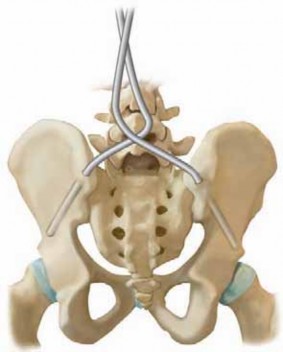 Illustration 23 for Optimizing Instrumentation for Neuromuscular Scoliosis