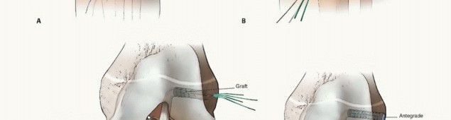 Illustration 21 for Optimizing ACL Reconstruction for Skeletally Immature Patients