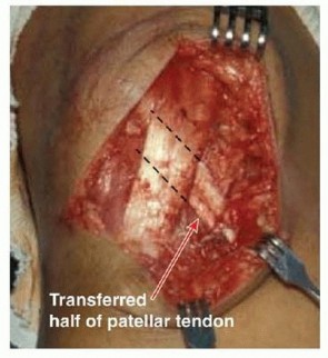 Illustration 21 for Chronic Patellar Instability: From Acute Onset to Lasting Solutions