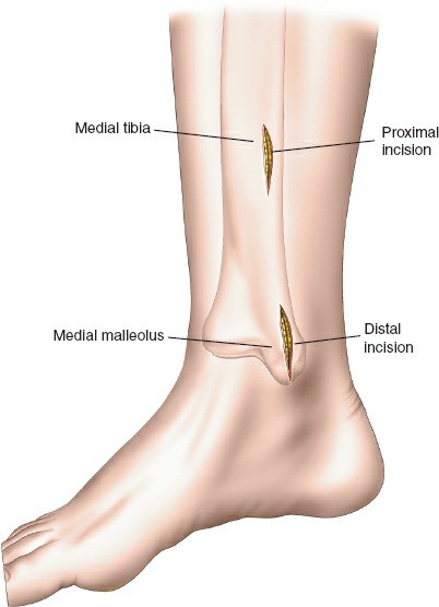 Illustration 65 for Surgical Access: Mastering the Tibia's Surface & Fibula Approaches