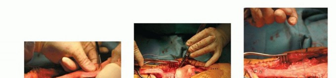 Illustration 13 for Patella Tendon Rupture Reconstruction in Revision TKA