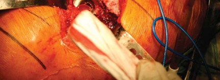 Illustration 39 for Metal on Metal Resurfacing: Enhanced Posterior Soft Tissue Repair