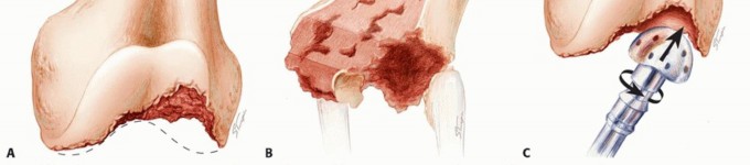 Illustration 5 for Optimizing Revision Femoral Component with Distal Femoral Bone Loss