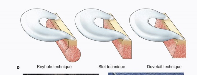 Illustration 11 for Symptomatic Knee? Meniscal Transplant for Anterior & Posterior Horns