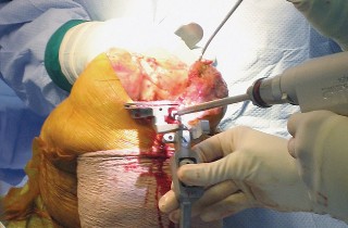 Illustration 18 for Posterior Stabilized Technique: Essential Insights for TKA Success