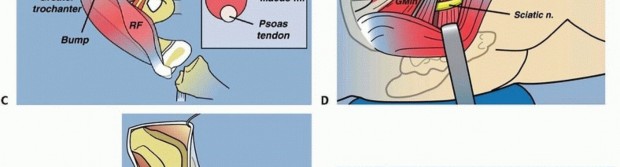 Illustration 19 for Treatment for Congenital Femoral Deficiency: What You Need to Know