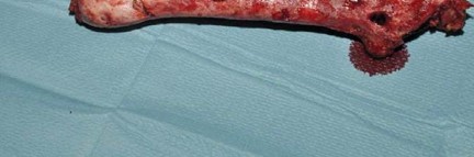 Illustration 78 for Optimizing Infected THA: The One Staged Approach Explained