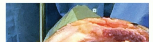 Illustration 38 for Achieve Lasting Pain Relief with Cemented Total Knee Arthroplasty