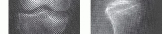 Illustration 24 for Dissecans of the Knee: What's the Difference – OCD vs. AVN?