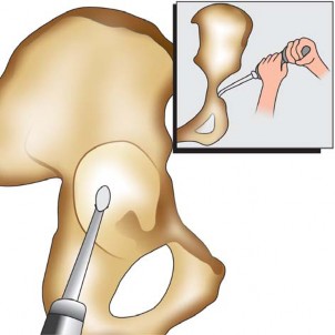 Illustration 109 for Successful Total Hip Replacement in Developmental Dysplasia