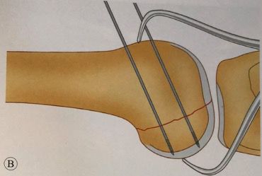 Arab Orthopaedic Board MCQs - Part 14