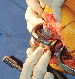 Illustration 35 for Mastering Gap Balancing in Revision TKA: Avoid Common Pitfalls