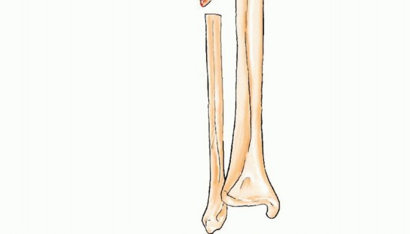 Illustration 7 for Free Vascularized Fibular Grafts: Solving Complex Bone Defects