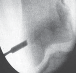 Illustration 4 for Percutaneous Epiphysiodesis: Precisely Closing the Third of the Physis