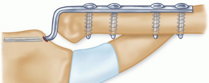 Illustration 29 for Optimizing SC Dislocation Repair After Medial Clavicle Resection