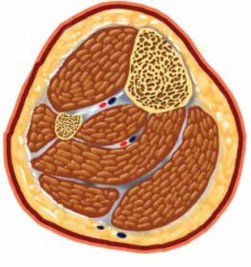 Illustration 2 for Optimal Nailing of the Tibia: Techniques for Challenging Fractures