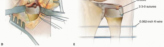Illustration 16 for Galeazzi DRUJ Stabilization: Unlocking Stability with Smooth Stainless Steel
