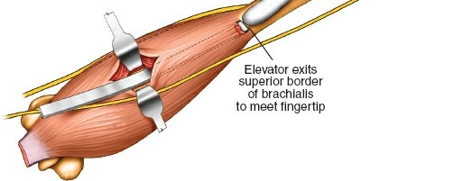 Illustration 30 for Mastering the Approach to the Distal Humerus: Safety & Skills