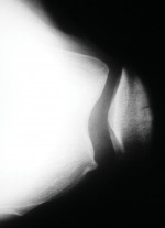 صورة طبية: جراحة استبدال مفصل الركبة الجزئي (UKA): تجنب الأخطاء والاستفادة القصوى في صنعاء مع الأستاذ الدكتور محمد هطيف