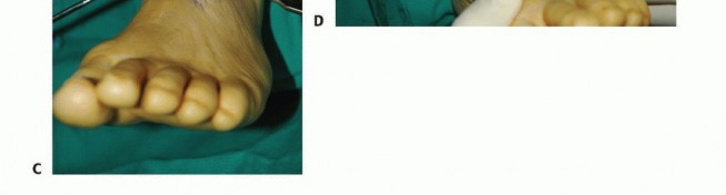 Illustration 32 for Foot Drop Surgery: How a Pin or Drill Elevates Tendon Transfer