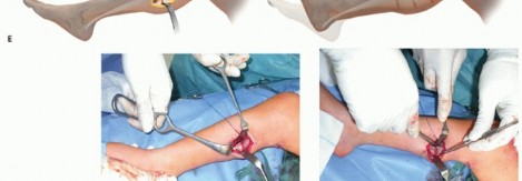 Illustration 41 for How Achilles Tendon Lengthening Fixes Equinocavovarus Foot