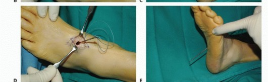 Illustration 36 for Foot Drop Surgery: How a Pin or Drill Elevates Tendon Transfer