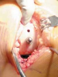 Illustration 19 for Knee Arthroplasty Unicondylar: Discover if Partial Knee Replacement is Right