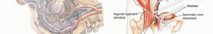 Illustration 2 for Posterior Flap Hemipelvectomy: Mastering Techniques for Optimal Outcomes