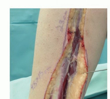 Illustration 31 for Free Vascularized Fibular Grafts: Solving Complex Bone Defects